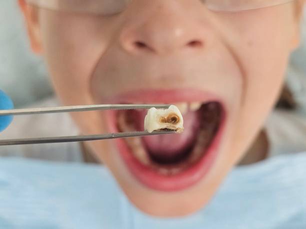 Best Urgent Tooth Repair  in Corona, CA